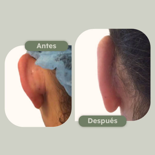 Otoplastia