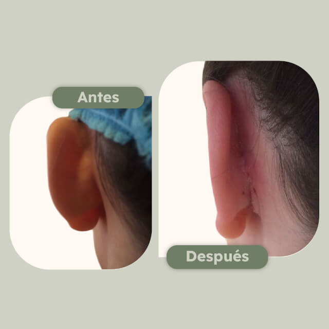 Otoplastia