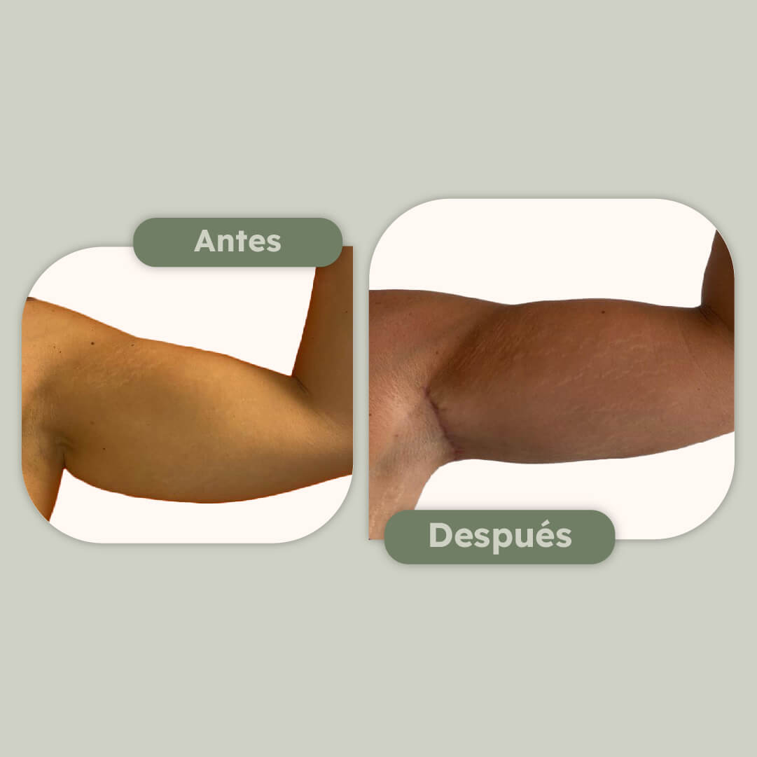 Lipo de brazos
