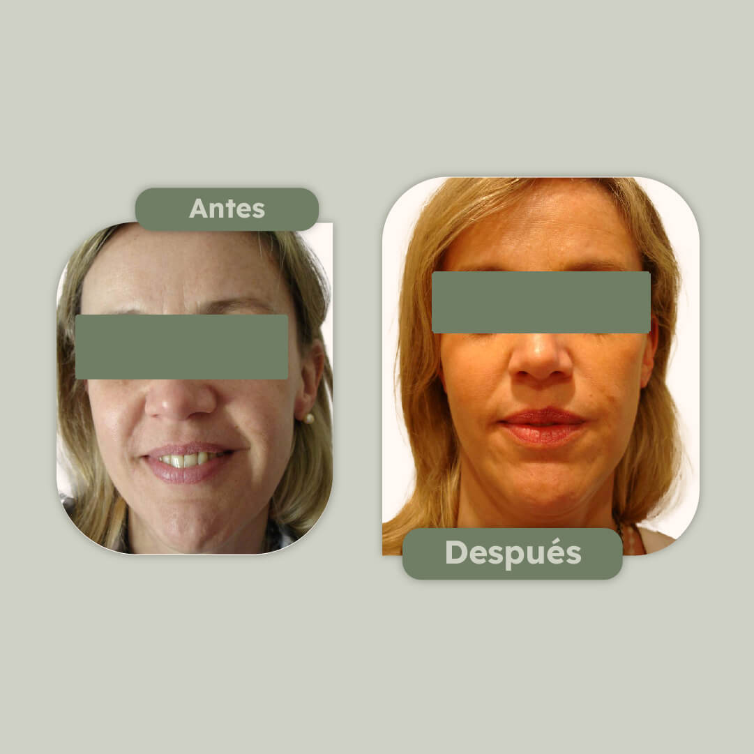 Rejuvenecimiento facial