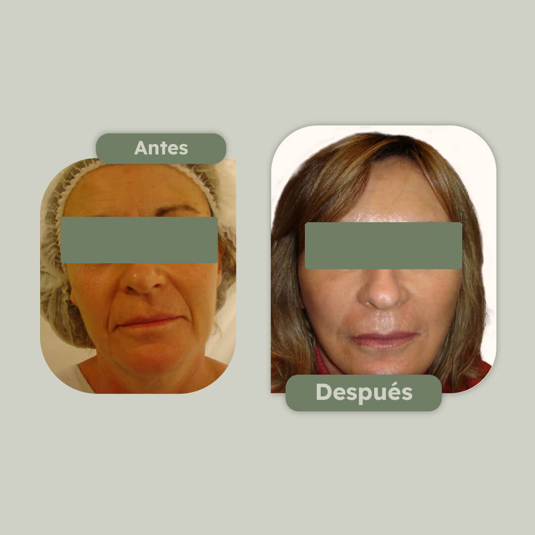 Rejuvenecimiento facial