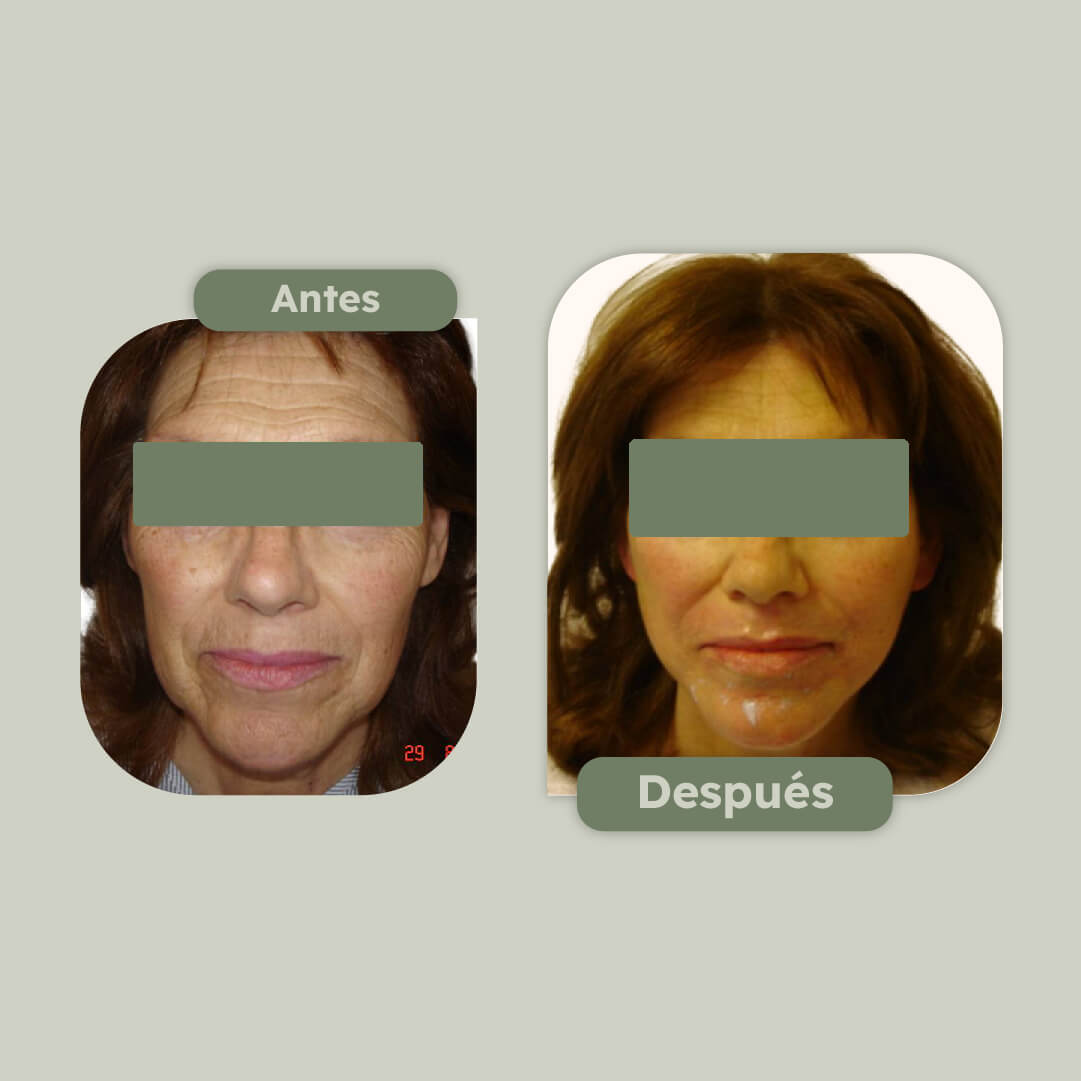 Rejuvenecimiento facial