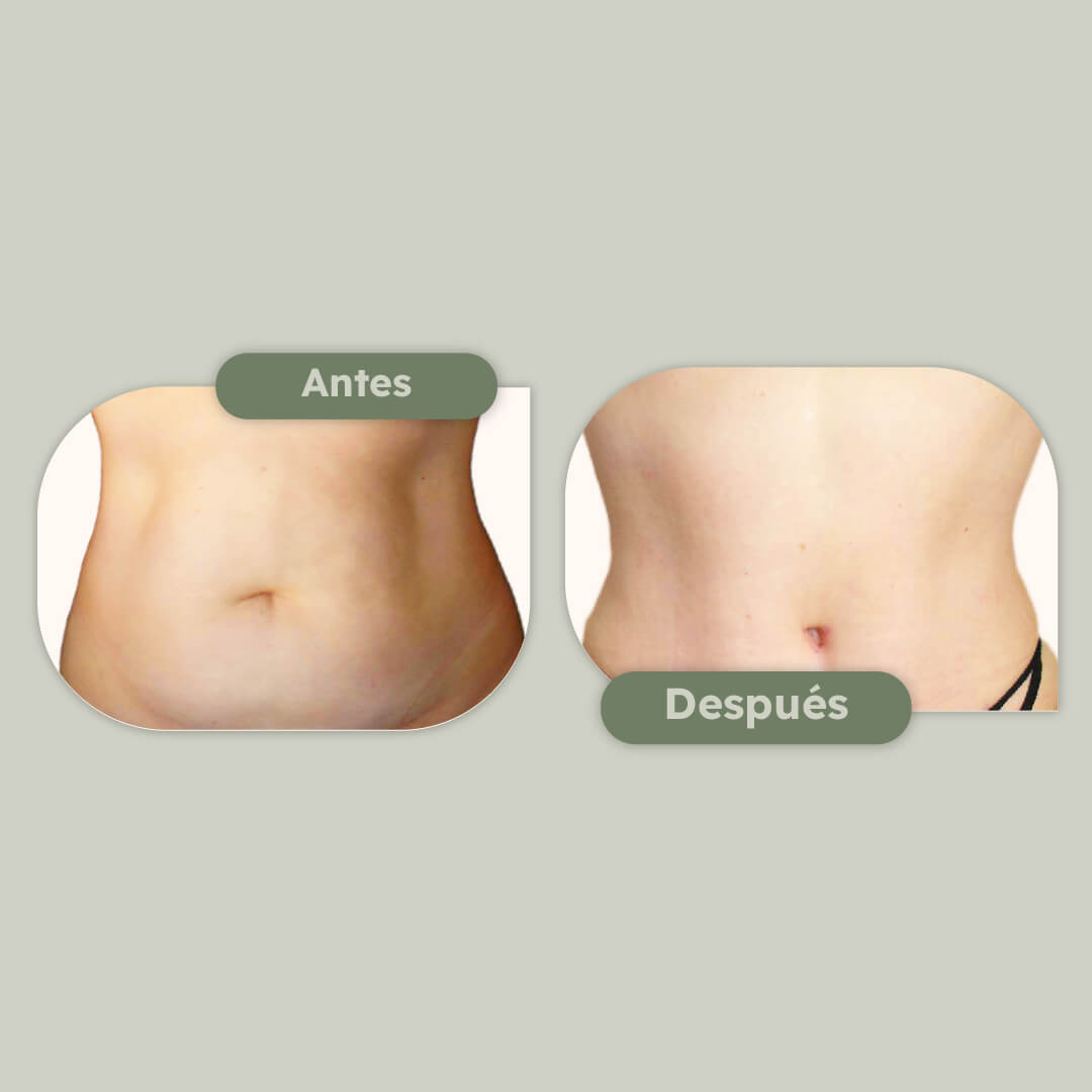 Atletización de abdomen