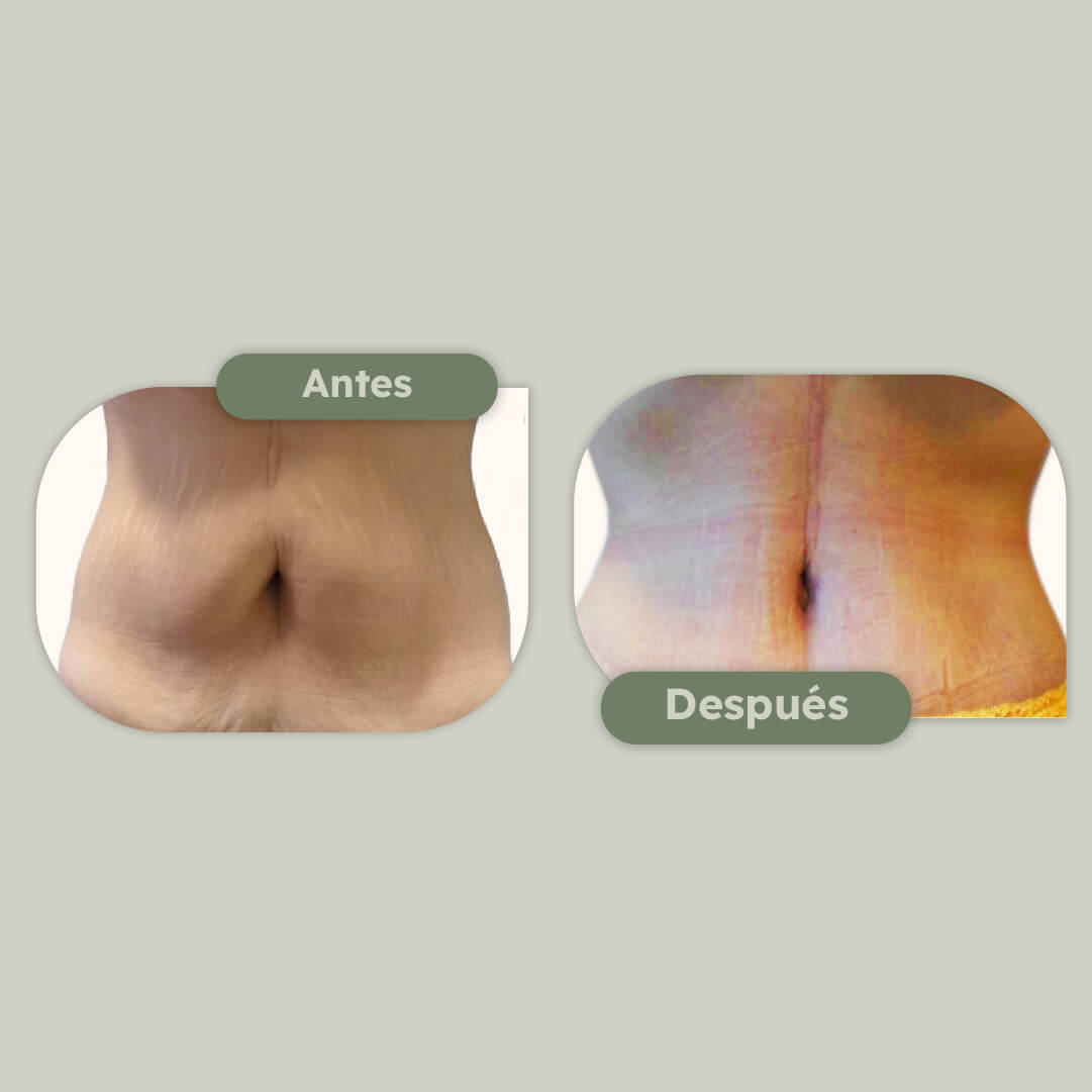Atletización de abdomen
