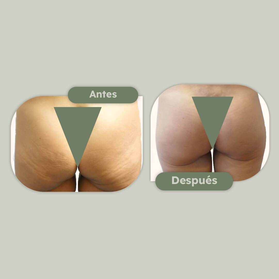 Aumento de gluteos