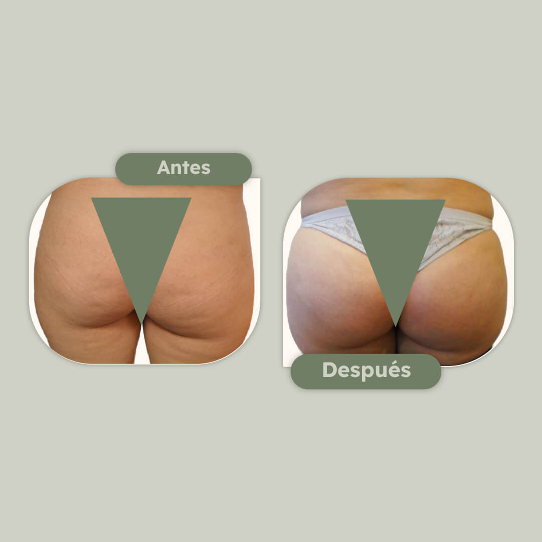 Aumento de gluteos