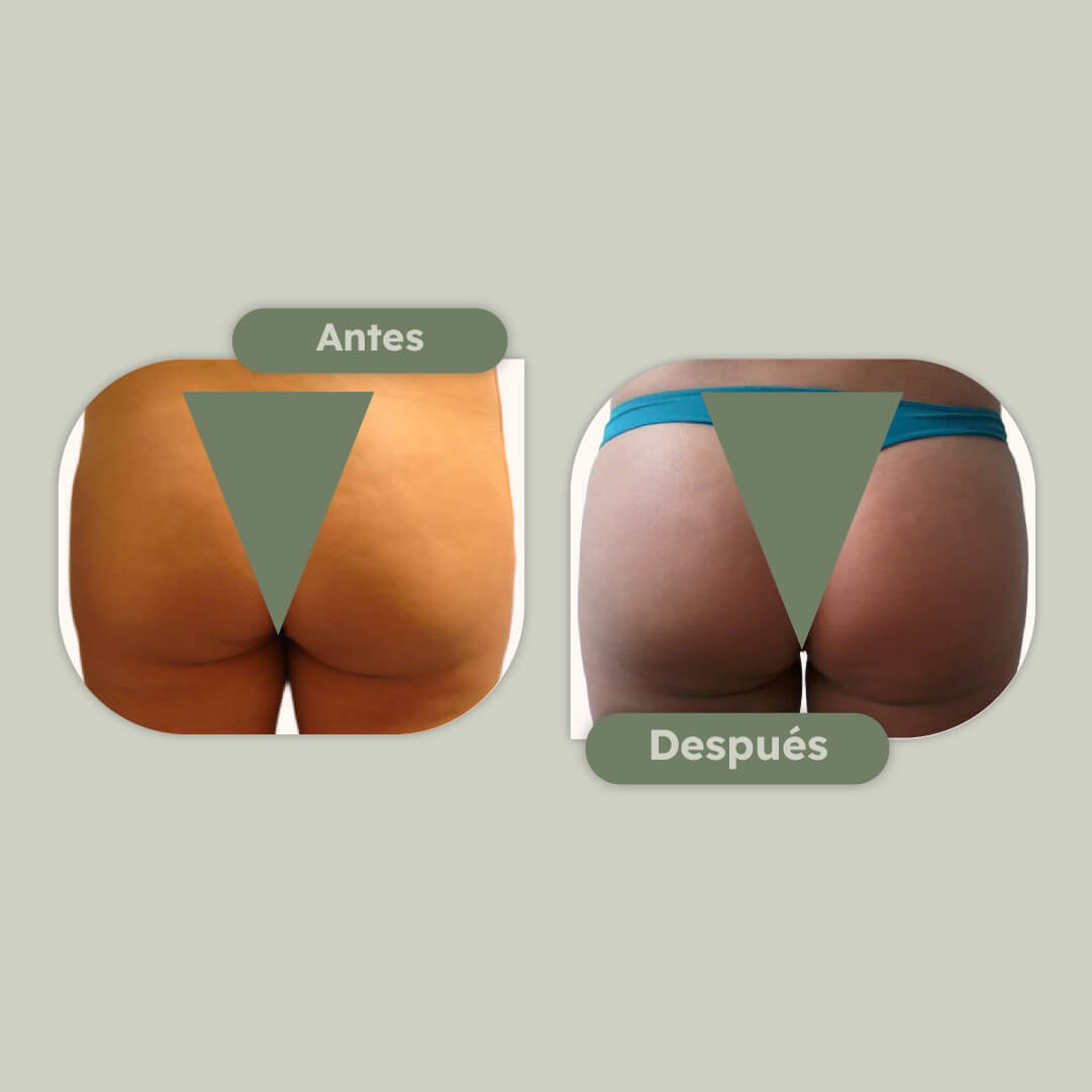 Aumento de gluteos