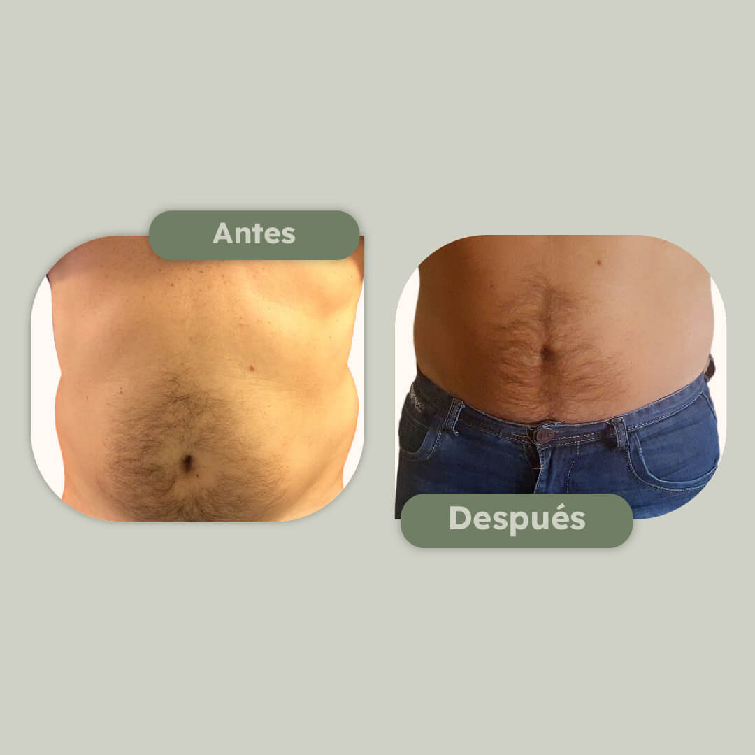 Flancoplastia
