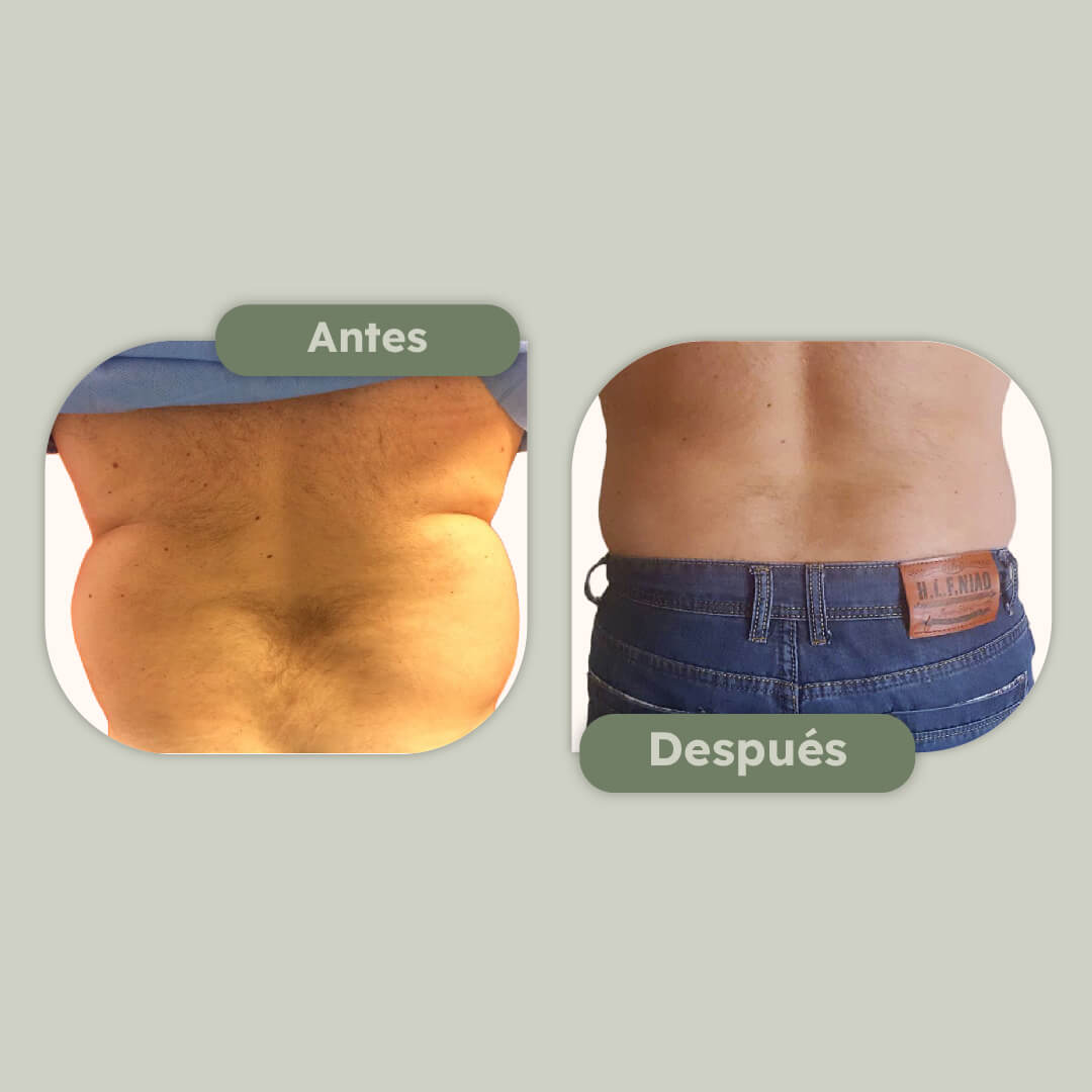 Flancoplastia