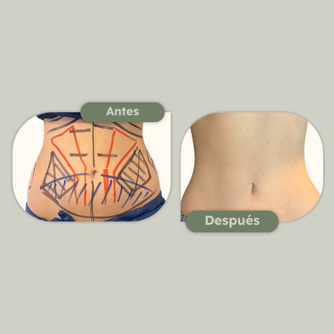 Lipoescultura