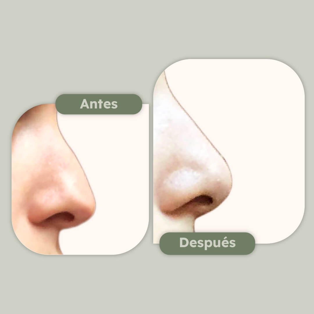 Rinoplastia