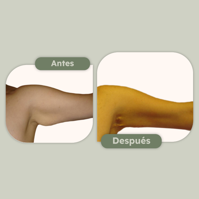  Lipo de brazos