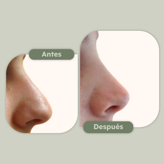 Rinoplastia