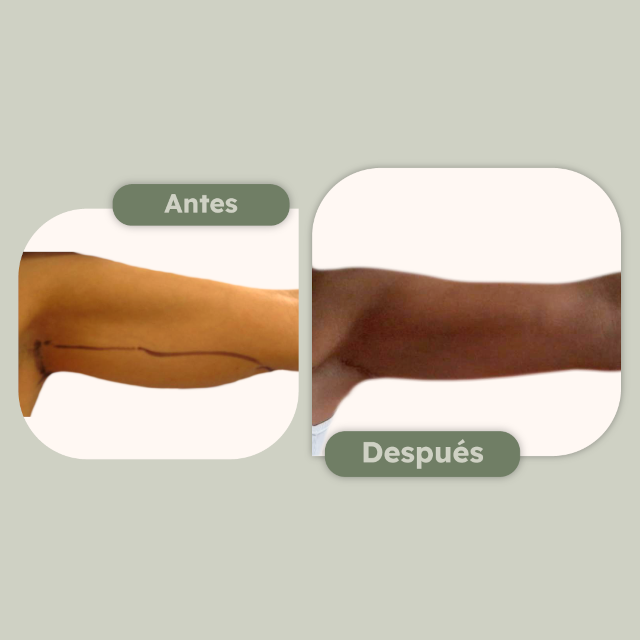  Lipo de brazos