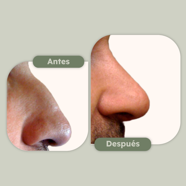 Rinoplastia